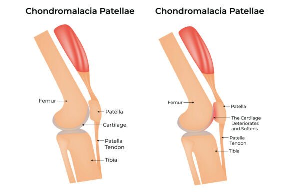Chondromalacia Patellae Medical Design